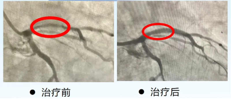 击碎心脏“拦路石”，重启生机获“心”生_05.png