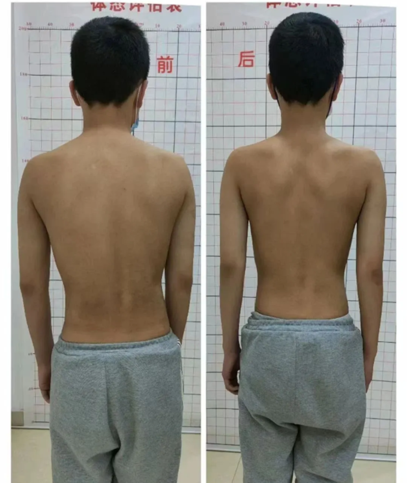孩子含胸、高低肩？5-18岁暑期脊柱矫正营来救场！_01.png